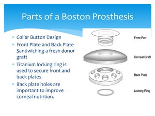 Parts of a Boston Prosthesis
 Collar Button Design
 Front Plate and Back Plate
Sandwiching a fresh donor
graft
 Titanium locking ring is
used to secure front and
back plates.
 Back plate holes are
important to improve
corneal nutrition.
 