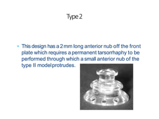  This design has a 2mm long anterior nub off the front
plate which requires apermanent tarsorrhaphy to be
performed through which a small anterior nub of the
type II modelprotrudes.
Type2
 
