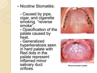 Nicotine Stomatitis Histopathology
