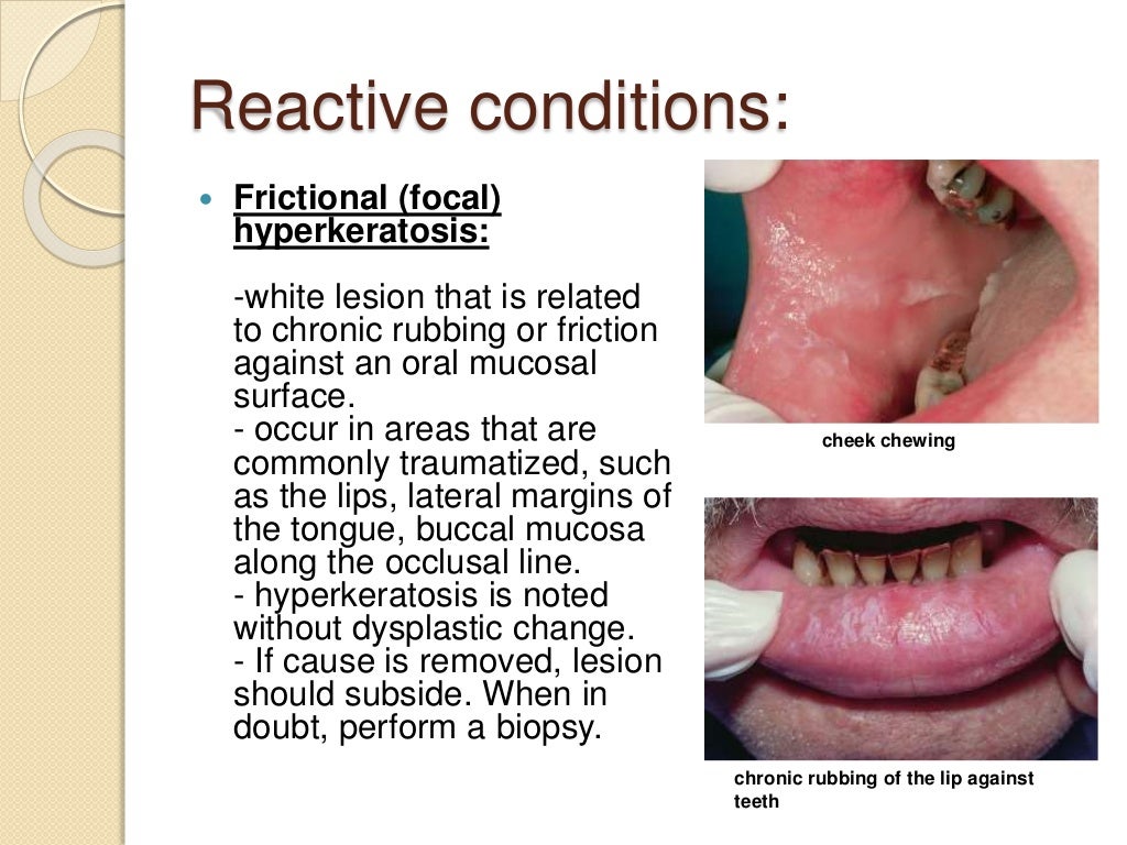 Keratosis andrelateddisorderoftheoralmucosa