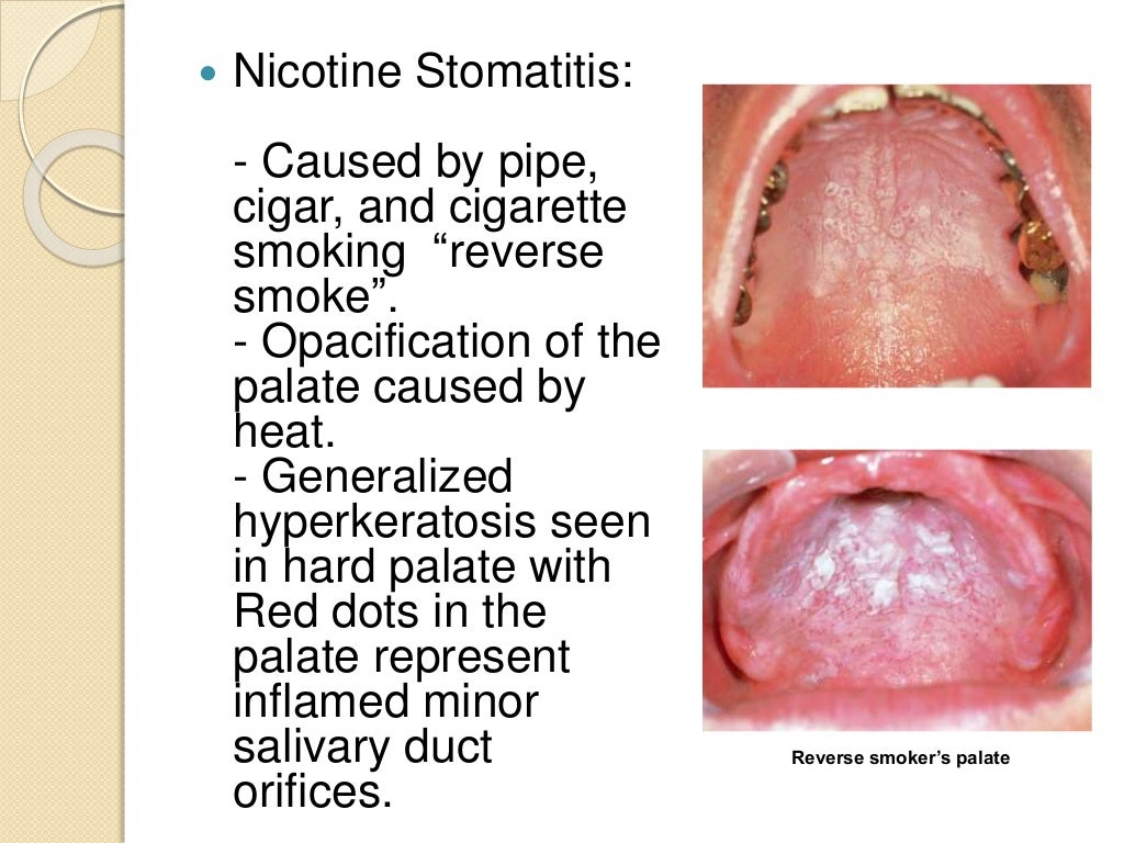 Keratosis andrelateddisorderoftheoralmucosa