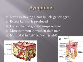    Starts by having a hair follicle get clogged
   Excess keratin is produced
   Looks like red goose-bumps or acne
   More common in women then men
   Normal skin (left) KP skin (right)
 