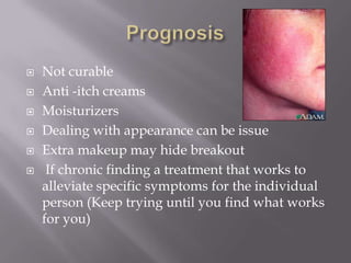    Not curable
   Anti -itch creams
   Moisturizers
   Dealing with appearance can be issue
   Extra makeup may hide breakout
    If chronic finding a treatment that works to
    alleviate specific symptoms for the individual
    person (Keep trying until you find what works
    for you)
 