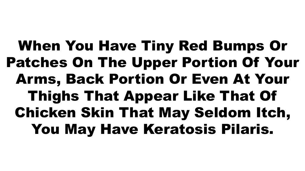 Keratosis pilaris, coconut oil keratosis pilaris, get rid of chicken
