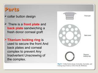 PartsParts
collar button design
 There is a front plate and
back plate sandwiching a
fresh donor corneal graft
Titanium locking ring is
used to secure the front And
back plates and corneal
complex to prevent Any
Inadvertent Unscrewing of
the complex.
 