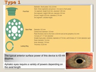 Type 1Type 1
The typical anterior surface power of this device is 43–44
dioptres.
Aphakic eyes require a variety of powers depending on
the axial length
 