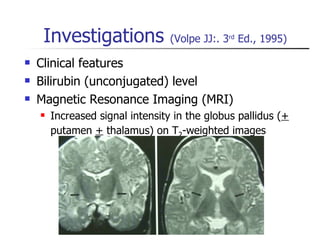 Investigations  (Volpe JJ:. 3 rd  Ed., 1995) Clinical features  Bilirubin (unconjugated) level Magnetic Resonance Imaging (MRI) Increased signal intensity in the globus pallidus ( +  putamen  +  thalamus) on T 2 -weighted images 