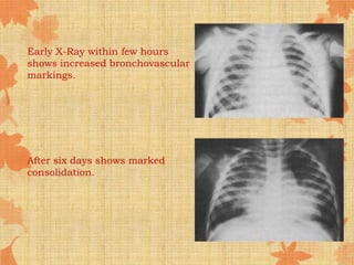 Early X-Ray within few hours
shows increased bronchovascular
markings.
After six days shows marked
consolidation.
 