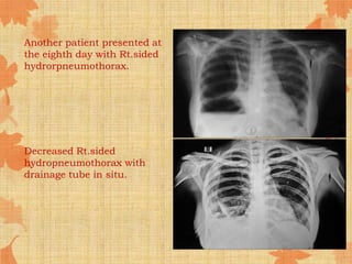 Another patient presented at
the eighth day with Rt.sided
hydrorpneumothorax.
Decreased Rt.sided
hydropneumothorax with
drainage tube in situ.
 