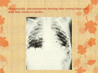 Occasionally, pneumatoceles develop after several days and
may take weeks to resolve.
 
