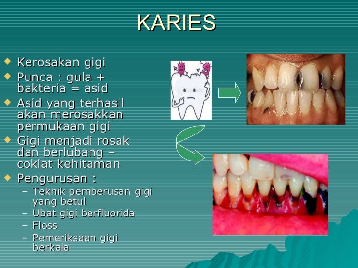 Ubat Gigi Berlubang Dan Gusi Bengkak - Harbolnas e