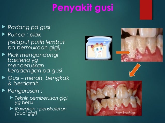 Ubat Gigi Putih - Contoh Akar