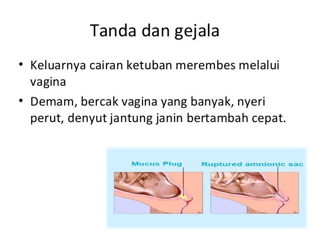 100+ Gambar Air Ketuban Rembes HD 100+ Gambar Air Ketuban Rembes HD