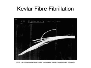 Kevlar Fibre Fibrillation
 