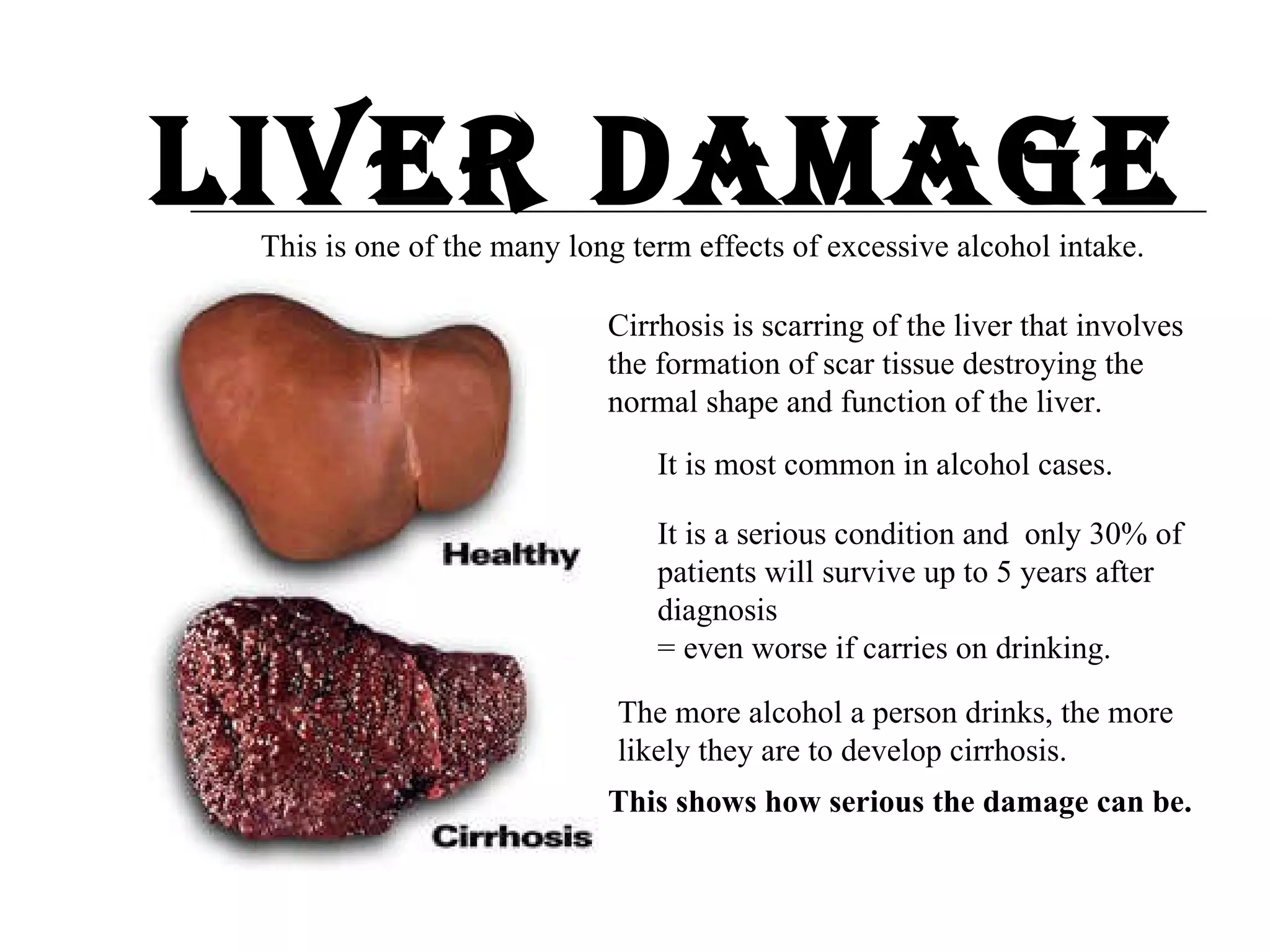 Liver Damage This is one of the many long term effects of excessive alcohol intake. Cirrhosis is scarring of the liver that involves the formation of scar tissue destroying the normal shape and function of the liver.  It is most common in alcohol cases. It is a serious condition and  only 30% of patients will survive up to 5 years after diagnosis = even worse if carries on drinking.  The more alcohol a person drinks, the more likely they are to develop cirrhosis. This shows how serious the damage can be. 