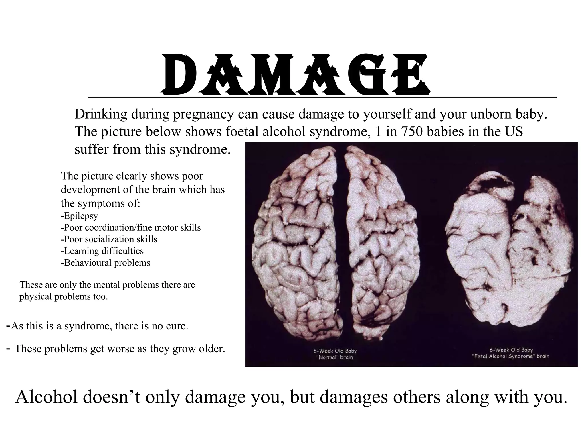 Damage Drinking during pregnancy can cause damage to yourself and your unborn baby. The picture below shows foetal alcohol syndrome, 1 in 750 babies in the US suffer from this syndrome. The picture clearly shows poor development of the brain which has the symptoms of: -Epilepsy  -Poor coordination/fine motor skills  -Poor socialization skills -Learning difficulties -Behavioural problems  - As this is a syndrome, there is no cure. -  These problems get worse as they grow older. These are only the mental problems there are physical problems too. Alcohol doesn’t only damage you, but damages others along with you. 