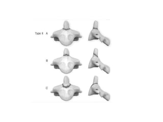 Cervical Spine Fractures and injuries classification | PPTX