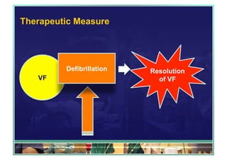 Therapeutic Measure 
VF 
Defibrillation Resolution 
of VF 
 