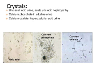 Crystals:
 Uric acid: acid urine, acute uric acid nephropathy
 Calcium phosphate in alkaline urine
 Calcium oxalate: hyperoxaluria, acid urine
Uric acid
Calcium
phosphate Calcium
oxalate
 