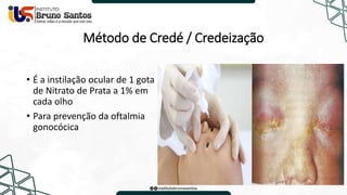 Método de Credé / Credeização
• É a instilação ocular de 1 gota
de Nitrato de Prata a 1% em
cada olho
• Para prevenção da oftalmia
gonocócica
 