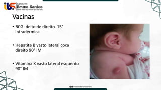 Vacinas
• BCG: deltoide direito 15°
intradérmica
• Hepatite B vasto lateral coxa
direito 90° IM
• Vitamina K vasto lateral esquerdo
90° IM
 