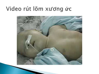 Khó thở da sua