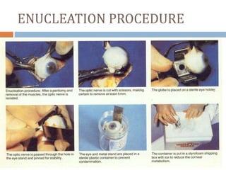 Enucleating Eye donation Eye banking and Keratoplasty KHALIL | PPTX