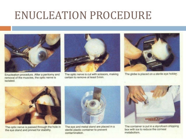 Essay eye donation keratoplasty 02 image