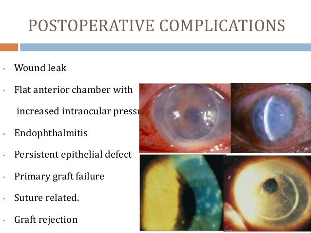 Essay eye donation keratoplasty 05 picture