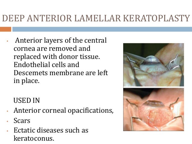Essay eye donation keratoplasty 06 picture