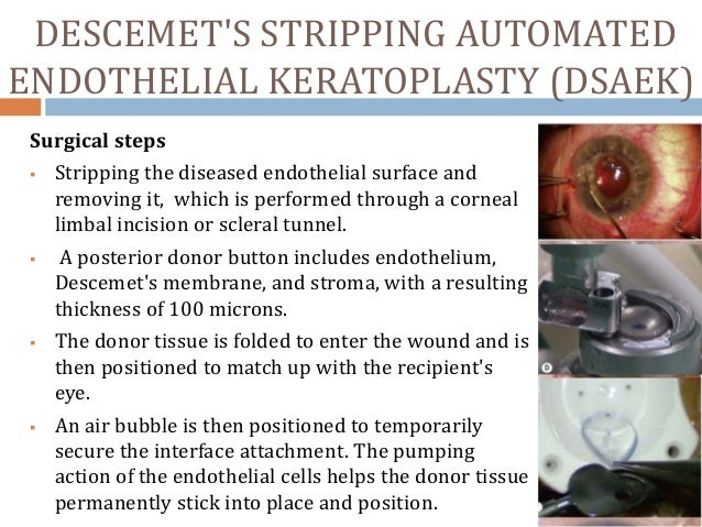 Essay eye donation keratoplasty picture