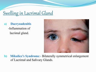 Swelling in Lacrimal Gland
a) Dacryoadenitis
-Inflammation of
lacrimal gland.
b) Mikulicz’s Syndrome:- Bilaterally symmetrical enlargement
of Lacrimal and Salivary Glands.
 