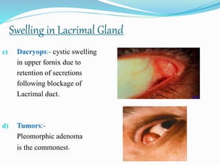 c) Dacryops:- cystic swelling
in upper fornix due to
retention of secretions
following blockage of
Lacrimal duct.
d) Tumors:-
Pleomorphic adenoma
is the commonest.
Swelling in Lacrimal Gland
 