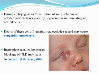 During embryogenesis Canalization of solid columns of
ectodermal cells takes place by degeneration and shredding of
central cells.
 Debris of these cells if remains may occlude sac and may cause
congenital mucocoele.
 Incomplete canalization causes
blockage of NLD may leads
to congenital dacryocystitis.
 