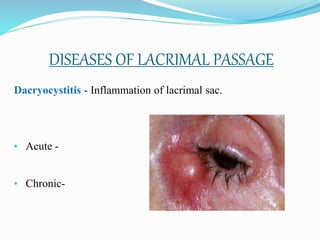 DISEASES OF LACRIMAL PASSAGE
Dacryocystitis - Inflammation of lacrimal sac.
• Acute -
• Chronic-
 
