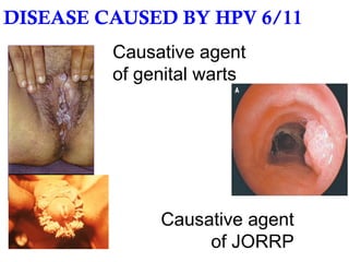 DISEASE CAUSED BY HPV 6/11 Causative agent of genital warts Causative agent of JORRP 