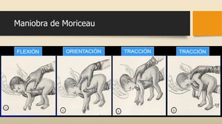 Maniobra de Moriceau
 