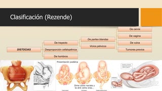 Clasificación (Rezende)
DISTOCIAS
De trayecto
De partes blandas
De cervix
De vagina
De vulva
Tumores previos
Vicios pélvicos
Desproporción cefalopélvica
De hombros
 