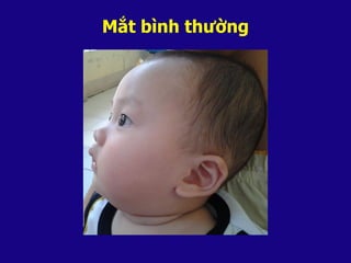 Mắt bình thường
 