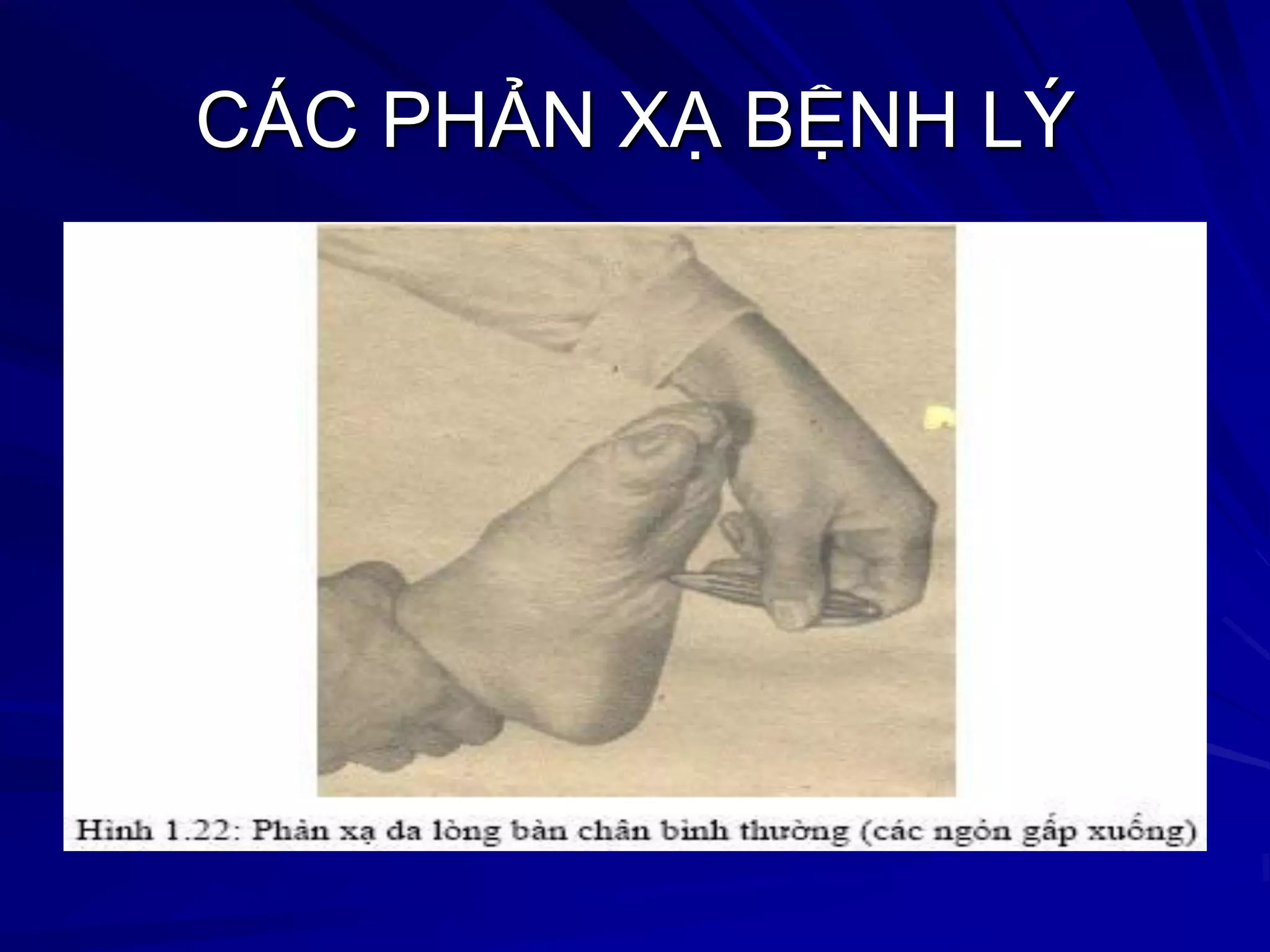CÁC PHẢN XẠ BỆNH LÝ
 