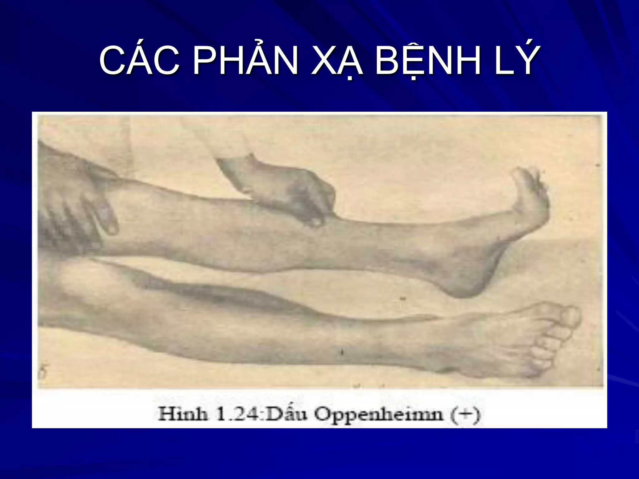 CÁC PHẢN XẠ BỆNH LÝ
 