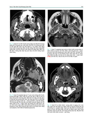 Các U Tân Sinh Của Khoang Cạnh Hầu 191
Fig. 15 Axial CT có tiêm thuốc tương phản cho thấy tổn thương
dạng nốt ở khoang sau mỏm trâm của PPS. Ấn tượng ban đầu
có thể nghĩ đến hạch sau hầu bệnh lý. Tuy nhiên, lòng động
mạch cảnh trong bị hẹp (đầu mũi tên trắng) nằm bên trong phần
ngoại biên của tổn thương, kèm đóng vôi ngoại biên (đầu mũi
tên đen): những dấu hiệu này phù hợp với phình động mạch
cảnh trong
Fig. 17 Axial T1-weighted spin echo có tiêm thuốc tương phản ở
bệnh nhân bị ung thư vòm hầu. Khối u xâm lân phía sau – ngoài
(mũi tên nhỏ) vào khoang sau mỏm trâm của PPS, và phần còn
lại được giới hạn rõ với khoang trước mỏm trâm bởi cơ căng
màn khẩu cái (đầu mũi tên) và cơ căng mỏm trâm – mạch máu
(TVS) (mũi tên lớn), mặc dù lớp mỡ hơi bị đẩy ra ngoài.
Fig. 16 Axial T2-weighted (a) và T1 spin echo không tiêm thuốc
tương phản (b) ở bệnh nhân 22 tuổi vào viện vì điếc tai trái và
triệu chứng khó nhai tăng dần. Một khối mô mềm (mũi tên đen)
ở mặt sâu của xương hàm dưới, lan rộng vào PPS; có thể thấy
một lớp mỡ mỏng ở mặt sau – trong của khối u (mũi tên trắng).
Tổn thương xâm lấn thùy sâu của tuyến mang tai. Ngược lại với
bệnh nhân ở Fig. 4, bệnh nhân này không còn thấy được các
cơ chân bướm, gợi ý điểm khởi phát của tổn thương nằm trong
khoang cơ nhai. Dịch trong khí bào chũm do rối loạn chức năng
vòi Eustache. Sinh thiết là rhabdomyosarcoma
Fig. 18 Axial CT có tiêm thuốc tương phản ở ngang mức vòm
hầu. Hạch sau hầu bệnh lý ở bệnh nhân bị ung thư tế bào gai của
cổ (không rõ u nguyên phát). Hạch sau hầu bệnh lý thường nằm
giữa cơ trước cột sống (đầu mũi tên) và động mạch cảnh trong
(mũi tên); hạch di căn lớn, như trong trường hợp này, đẩy lệch lớp
mỡ trước mỏm trâm ra trước – vào trong.
 
