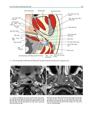 Các U Tân Sinh Của Khoang Cạnh Hầu 183
Mỏm chân bướm Khoang nhai Xương hàm dưới
Lớp nông của mạc
cổ sâu
Cơ căng màn
khẩu cái
Vòi Eustache
Cơ nâng màn
khẩu cái
Mạc hầu
nền
Mạc hầu miệng
Mạc cánh
Mạc trước cột
sống
Hạch sau hầu
Mạc
Charpyls
Mạc căng mỏm trâm –
mạch máu
Mạc trâm hầu
Tuyến mang tai
(thùy sâu)
Mỏm trâm
Tĩnh mạch cảnh trong
Cơ nhị thân (bụng
sau)
Mỏm chũm
Chuỗi hạch giao cảm Động mạch cảnh trong Thần kinh
lang thang
Lớp sâu của mạc
cổ sâu
Fig. 2 Hình vẽ giải phẫu của PPS trên mặt phẳng axial, bao gồm những lớp mạc khác nhau ở ngang mức này
Fig. 3 Axial T1-weighted spin echo có tiêm thuốc tương phản,
cho thấy mối liên hệ giữa cơ khít hầu trên, mạc hầu nền và ung
thư vòm hầu. a Lát cắt axial ngang mức khẩu cái mềm. Cơ khí
hầu trên (đầu mũi tên) bao quanh vòm hầu, khối u (dấu sao)
nằm trong lòng vòm hầu
b Ở mức cao hơn, lòng vòm hầu được bao quanh bởi mạc hầu
nền (đầu mũi tên). Ở hai bên, cơ căng màn khẩu cái (mũi tên
đen) thấy ở mặt ngoài của lớp mạc này. Ở bên phải, khối u xâm
lấn vào PPS qua mạc hầu nền (mũi tên trắng); vị trí này tương
ứng với xoang Morgagni
 