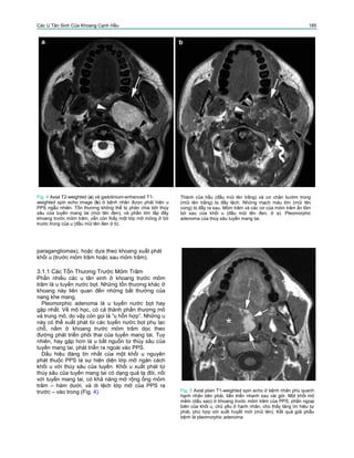 Các U Tân Sinh Của Khoang Cạnh Hầu 185
Fig. 4 Axial T2-weighted (a) và gadolinium-enhanced T1-
weighted spin echo image (b) ở bệnh nhân được phát hiện u
PPS ngẫu nhiên. Tổn thương không thể bị phân chia bởi thùy
sâu của tuyến mang tai (mũi tên đen), và phần lớn lấp đầy
khoang trước mỏm trâm, vẫn còn thấy một lớp mỡ mỏng ở bờ
trước trong của u (đầu mũi tên đen ở b).
Thành của hầu (đầu mũi tên trắng) và cơ chân bướm trong
(mũi tên trắng) bị đẩy lệch. Những mạch máu lớn (mũi tên
cong) bị đẩy ra sau. Mỏm trâm và các cơ của mỏm trâm ấn lõm
bờ sau của khối u (đầu mũi tên đen, ở a). Pleomorphic
adenoma của thùy sâu tuyến mang tai.
paragangliomas), hoặc dựa theo khoang xuất phát
khối u (trước mỏm trâm hoặc sau mỏm trâm).
3.1.1 Các Tổn Thương Trước Mỏm Trâm
Phần nhiều các u tân sinh ở khoang trước mỏm
trâm là u tuyến nước bọt. Những tổn thương khác ở
khoang này liên quan đến những bất thường của
nang khe mang.
Pleomorphic adenoma là u tuyến nước bọt hay
gặp nhất. Về mô học, có cả thành phần thượng mô
và trung mô, do vậy còn gọi là “u hỗn hợp”. Những u
này có thể xuất phát từ các tuyến nước bọt phụ lạc
chỗ, nằm ở khoang trước mỏm trâm dọc theo
đường phát triển phôi thai của tuyến mang tai. Tuy
nhiên, hay gặp hơn là u bắt nguồn từ thùy sâu của
tuyến mang tai, phát triển ra ngoài vào PPS.
Dấu hiệu đáng tin nhất của một khối u nguyên
phát thuộc PPS là sự hiện diện lớp mỡ ngăn cách
khối u với thùy sâu của tuyến. Khối u xuất phát từ
thùy sâu của tuyến mang tai có dạng quả tạ đôi, nối
với tuyến mang tai, có khả năng mở rộng ống mỏm
trâm – hàm dưới, và di lệch lớp mỡ của PPS ra
trước – vào trong (Fig. 4). Fig. 5 Axial plain T1-weighted spin echo ở bệnh nhân phù quanh
hạnh nhân bên phải, tiến triển nhanh sau vài giờ. Một khối mô
mềm (dấu sao) ở khoang trước mỏm trâm của PPS; phần ngoại
biên của khối u, chủ yếu ở hạnh nhân, cho thấy tăng tín hiệu tự
phát, phù hợp với xuất huyết mới (mũi tên). Kết quả giải phẫu
bệnh là pleomorphic adenoma
 