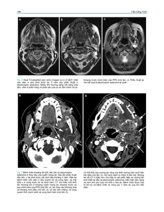 186 Trần Công Trình
Fig. 6 Axial T2-weighted spin echo images (a–c) ở bệnh nhân
vào viện vì phù phía dưới tai, 9 năm sau phẫu thuật vì
pleomorphic adenoma. Nhiều tổn thương dạng nốt sáng (mũi
tên), nằm ở phần nông và phần sâu của cơ ức đòn chũm và cả
khoang trước mỏm trâm của PPS (mũi tên, c). Phẫu thuật lại
cho kết quả là pleomorphic adenoma tái phát
Fig. 7 Bệnh nhân khoảng 50 tuổi, tiền căn có pleomorphic
adenoma ở thùy sâu của tuyến mang tai. Sau lần phẫu thuật
đầu tiên, u tái phát được cắt cách đây khoảng 1 năm. Hiện tại
bệnh nhân vào viện vì đau quanh tai và cứng hàm, và một
khối u ở vùng trước tai và dưới hàm. CT cho thấy một khối
tổn thương lớn ở khoang tuyến mang tai, khoang trước và
sau mỏm trâm của PPS (mũi tên, a), lan rộng vào khoang nhai
và khoang mút (đầu mũi tên, a), và vào sàn miệng, và vùng
quanh tĩnh mạch cảnh và vùng dưới hàm (mũi tên, b).
Có thể thấy hủy xương lan rộng của thân xương hàm dưới bên
trái (đầu mũi tên, b). Vài hạch bệnh lý nhóm II bên trái. Những
lát cắt CT ở thấp hơn cho thấy di căn phổi. Mặc dù những lần
sinh thiết lại đều là pleomorphic adenoma, biểu hiện lâm sàng
và hình ảnh phù hợp với khối u hóa ác. Bệnh nhân được hóa
trị hỗ trợ và bệnh nhân tử vong sau 1 năm do ung thư tiến
triển.
 