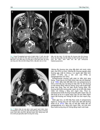 188 Trần Công Trình
Fig. 9 Axial T2-weighted spin echo ở bệnh nhân 11 tuổi, vào viện
vì đau mặt, chủ yếu khi nhai, giảm thính lực bên phải và sụt cân.
Một khối u lớn (dấu sao) có trung tâm ở PPS bên phải, lan rộng
vào lòng vòm hầu (mũi tên trắng). Khối u đẩy lệch các cơ nhai
(đầu mũi tên đen). Có thể thấy tổn thương xâm lấn khoang
trước cột sống (đầu mũi tên trắng) và đỉnh xương đá bên phải
(mũi tên đen). Sinh thiết cho kết quả embryonal
rhabdomyosarcoma
Fig. 10 Bệnh nhân nhi vào viện vì phù quanh hạnh nhân. Axial
T2-weighted spin echo cho thấy một khối dạng nang ở khoang
trước mỏm trâm của PPS, đẩy lệch thành hầu. Nang được cắt
bỏ và kết quả giải phẫu bệnh là nang khe mang
Những tổn thương này cũng đẩy lệch mỡ trước mỏm
trâm của PPS ra trước. Những tổn thương nguyên phát
thường gặp nhất là những u có nguồn gốc thần kinh
(chiếm 17–25% các u tân sinh của PPS) và
paragangliomas (10–15%).
Schwannomas thường xuất phát từ thần kinh lang
thang. Thoái hóa ác tính hiếm được báo cáo (Al Otieshan
et al. 1998). Biểu hiện MR điển hình của schwannoma là
khối u hình bầu dục hơi tăng tín hiệu trên T2; tổn thương
có thể không đồng nhất do những vùng xuất huyết hoặc
thoái hóa nang. Sau khi tiêm thuốc tương phản, tổn
thương bắt thuốc tương phản mạnh và có thể chẩn đoán
nhầm với những u tăng sinh mạch máu. Thực ra,
schwannoma là tổn thương tương đối giảm mạch máu và
bắt thuốc là do rò rỉ ngoài mạch máu do tính thấm thành
mạch bất thường với những hồ dẫn lưu tĩnh mạch (Fig.
12).
Hiếm gặp hơn, có thể thấy flow voids ở schwannoma
ngoài sọ, tương ứng với các mạch máu dãn bất thường
(Kato et al. 2010); điều này có thể gây nhầm lẫn với
paraganglioma, là u tăng sinh mạch máu, với hình ảnh
flow voids tương ứng với những động mạch nuôi hoặc
 