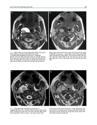 Các U Tân Sinh Của Khoang Cạnh Hầu 189
Fig. 11 Bệnh nhân nữ 42 tuổi không triệu chứng, phù quanh
hạnh nhân bên phải được phát hiện tình cờ. Axial
T2-weighted (a) và gadolinium-enhanced T1-weighted
(b) spin echo cho thấy khối dạng nang lớn, lấp đầy khoang
trước mỏm trâm của PPS. Khối u có trung tâm nằm giữa cơ
trước cột sống (đầu mũi tên đen) và động mạch cảnh trong
(đầu mũi tên trắng), vị trí điển hình của hạch sau hầu bệnh lý
Động mạch cảnh trong và tĩnh mạch cảnh trong (mũi tên trắng)
bị đẩy lệch ra phía sau – ngoài. Khối u dạng nang chứa thành
phần đặc bắt thuốc tương phản. Tổn thương với biểu hiện như
trên, đặc biệt ở bệnh nhân nữ trẻ, cần nghi ngờ ung thư tuyến
giáp dạng nhú di căn, chẩn đoán này sau cùng đã được xác
định.
Fig. 12 T2-weighted (a) và gadolinium-enhanced T1-
weighted (b) spin echo, cho thấy khối tổn thương không đồng
nhất ở khoang sau mỏm trâm của PPS, đẩy lệch động mạch
cảnh trong (đầu mũi tên) ra trước – vào trong, và tĩnh mạch
cảnh trong (mũi tên) theo hướng sau – ngoài. Những dấu hiệu
này phù hợp với schwannoma, chủ yếu xuất phát từ thần kinh
lang thang. Do tổn thương này ít gây triệu chứng, bệnh nhân
được điều trị bảo tồn và theo dõi.
 