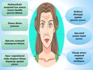 Нүднүүдийн
хооронд гүн ховил
эсвэл толбо
үүссэн байна.
Зовхи доош
унжина.
Арьсны сүвнүүд
томорсон байна.
Арьс хуурайшиж
хоёр хацрын дагуу
биржгэр зураас
үүснэ.
Нүдний
доогуур
зураас
үрчлээ үүснэ.
Арьсанд
улаан туяа
үүснэ.
Хацар амны
хооронд
зураас
тодорно.
 