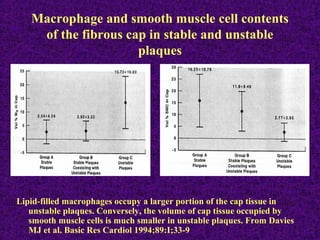 Macrophage and smooth muscle cell contents
of the fibrous cap in stable and unstable
plaques
Lipid-filled macrophages occupy a larger portion of the cap tissue in
unstable plaques. Conversely, the volume of cap tissue occupied by
smooth muscle cells is much smaller in unstable plaques. From Davies
MJ et al. Basic Res Cardiol 1994;89:I;33-9
 