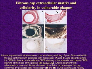 Fibrous cap extracellular matrix and
cellularity in vulnerable plaques
Arterial segment with atheromatous core with heavy staining of picro Sirius red within
the cap confirmed with polarized light microscopy (A and C), and absent staining
for CD68 in the cap and moderate CD68 staining in the shoulder and heavy CD68
staining at the base of the plaque (E) (asterick). Arterial segment with
atheromatous core and thin/local absent picro Sirius red staining of the cap
confirmed by polarized light microscopy (B and D). CD68 staining was heavily
 